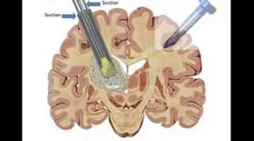 Brain Surgery - Avinash